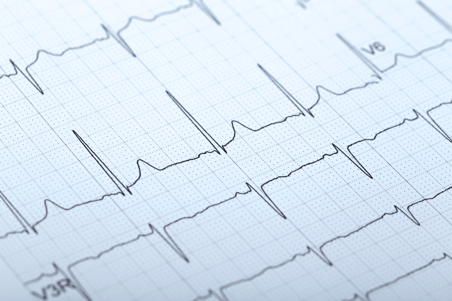 ECG-a-riposo